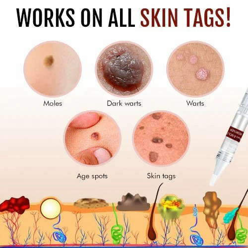 (🔥Last day promotion 30% off)Nano-X Tags & Moles Remover