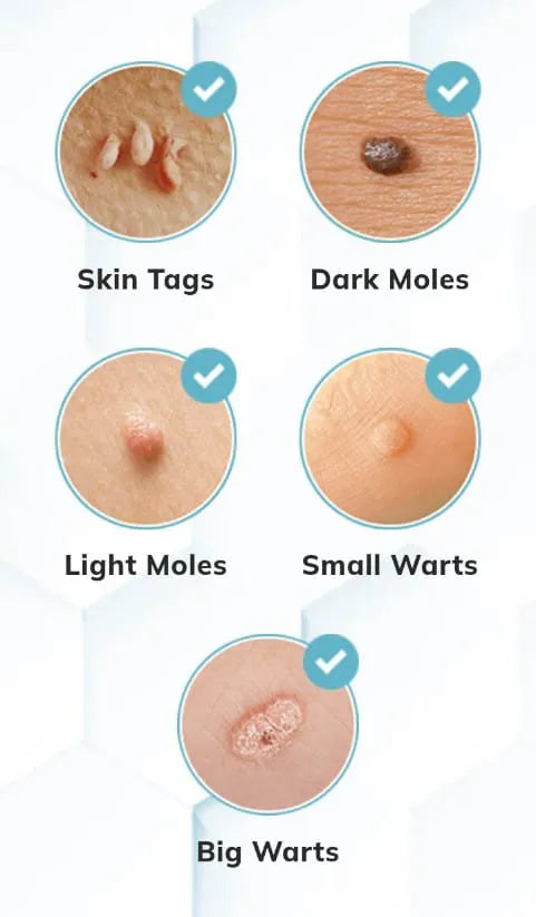 (🔥Last day promotion 30% off)Nano-X Tags & Moles Remover