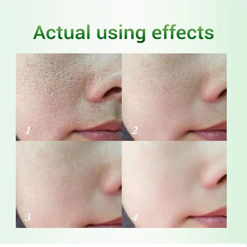 Salicylic Acid Pore Refinemen tSkin Care Cream